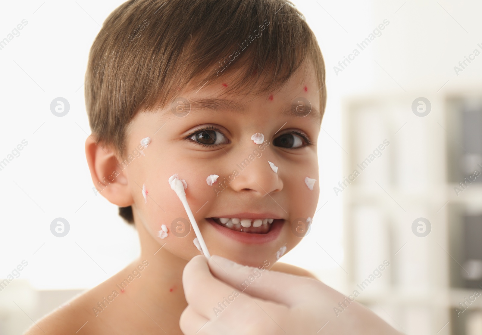 Photo of Doctor applying cream onto skin of little boy with chickenpox in clinic. Varicella zoster virus