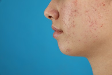 Photo of Teenage girl with acne problem on blue background, closeup