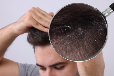 Man suffering from dandruff on light background, closeup. View through magnifying glass on hair with flakes