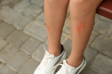 Photo of Girl with insect bites on legs outdoors, closeup