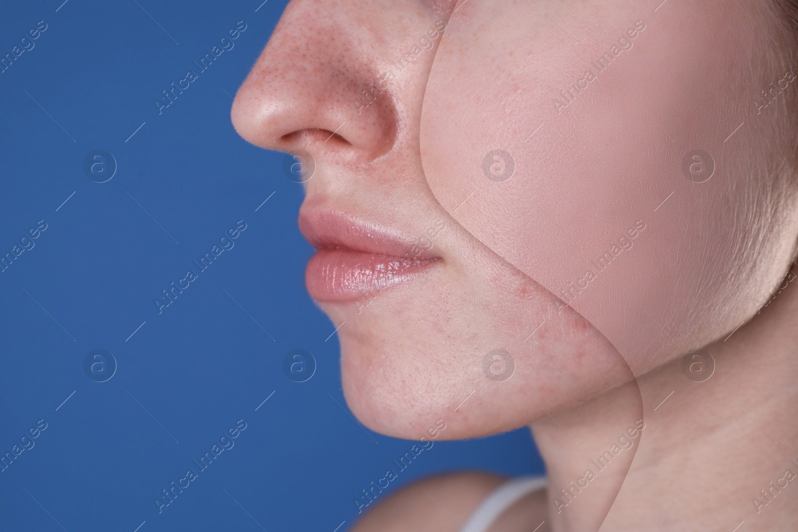 Image of Acne problem, collage. Woman before and after treatment on blue background, closeup. Space for text