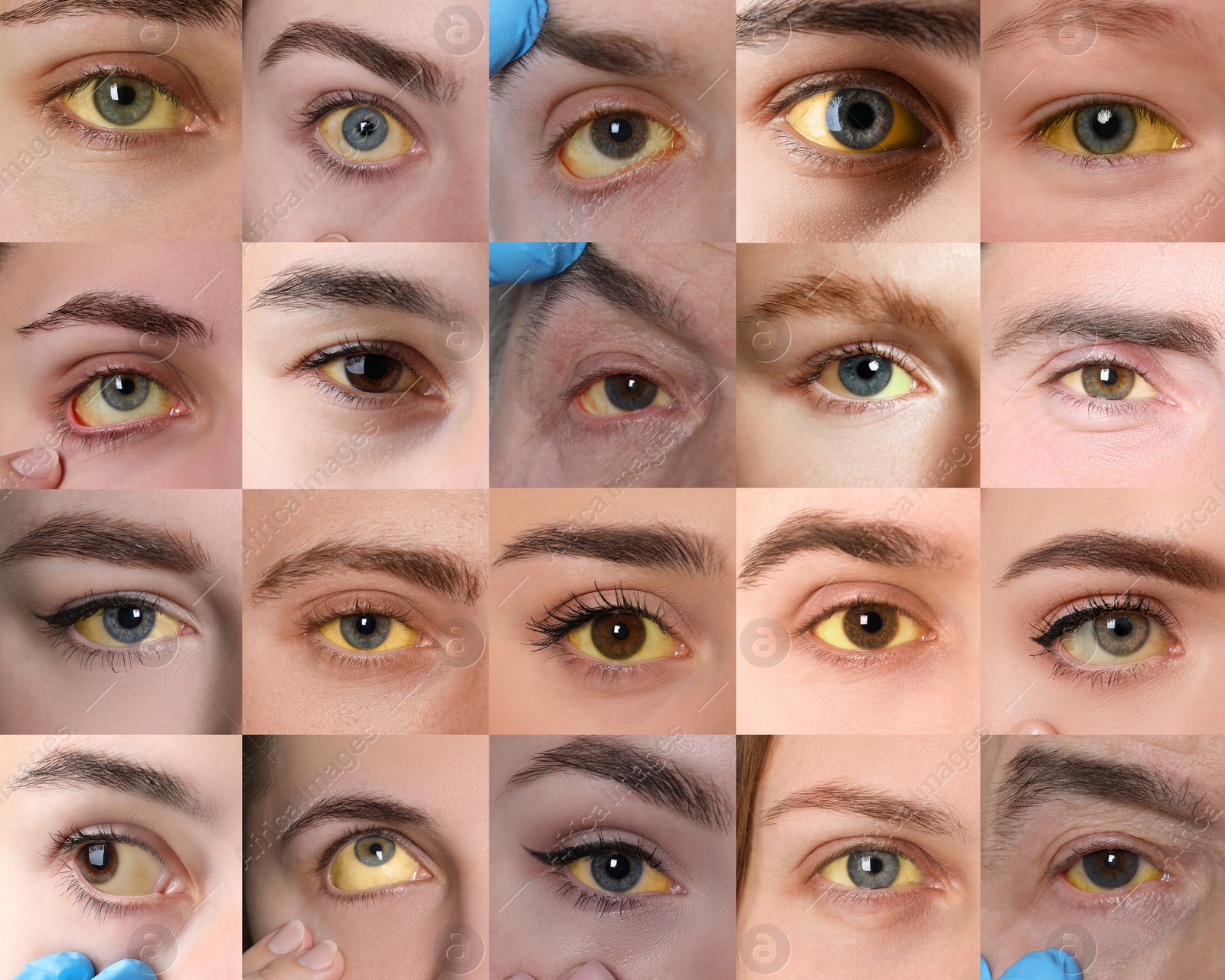 Image of Yellowing of eyes as symptom of hepatitis. Collage with photos of people
