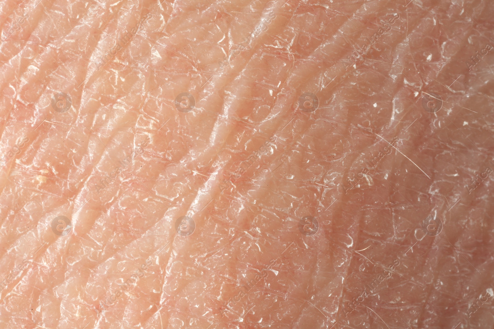 Photo of Texture of dry skin as background, macro view