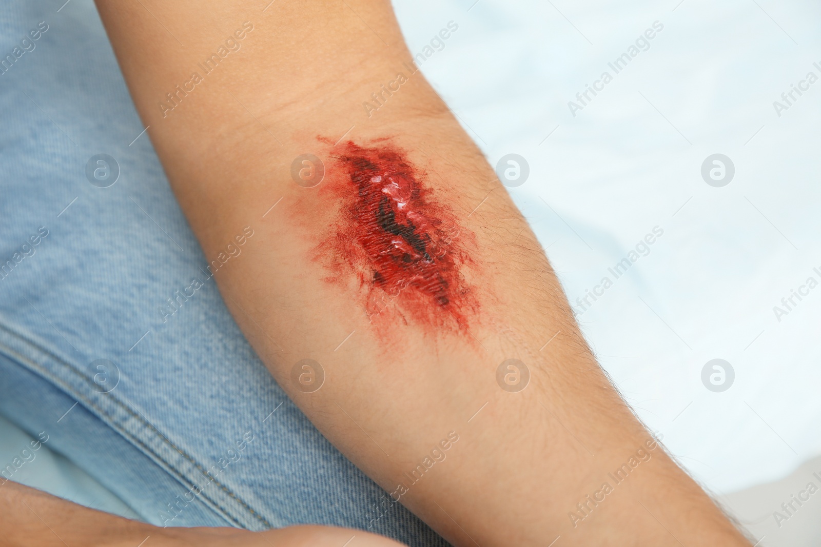 Photo of Young man with injured arm in clinic, closeup. First aid