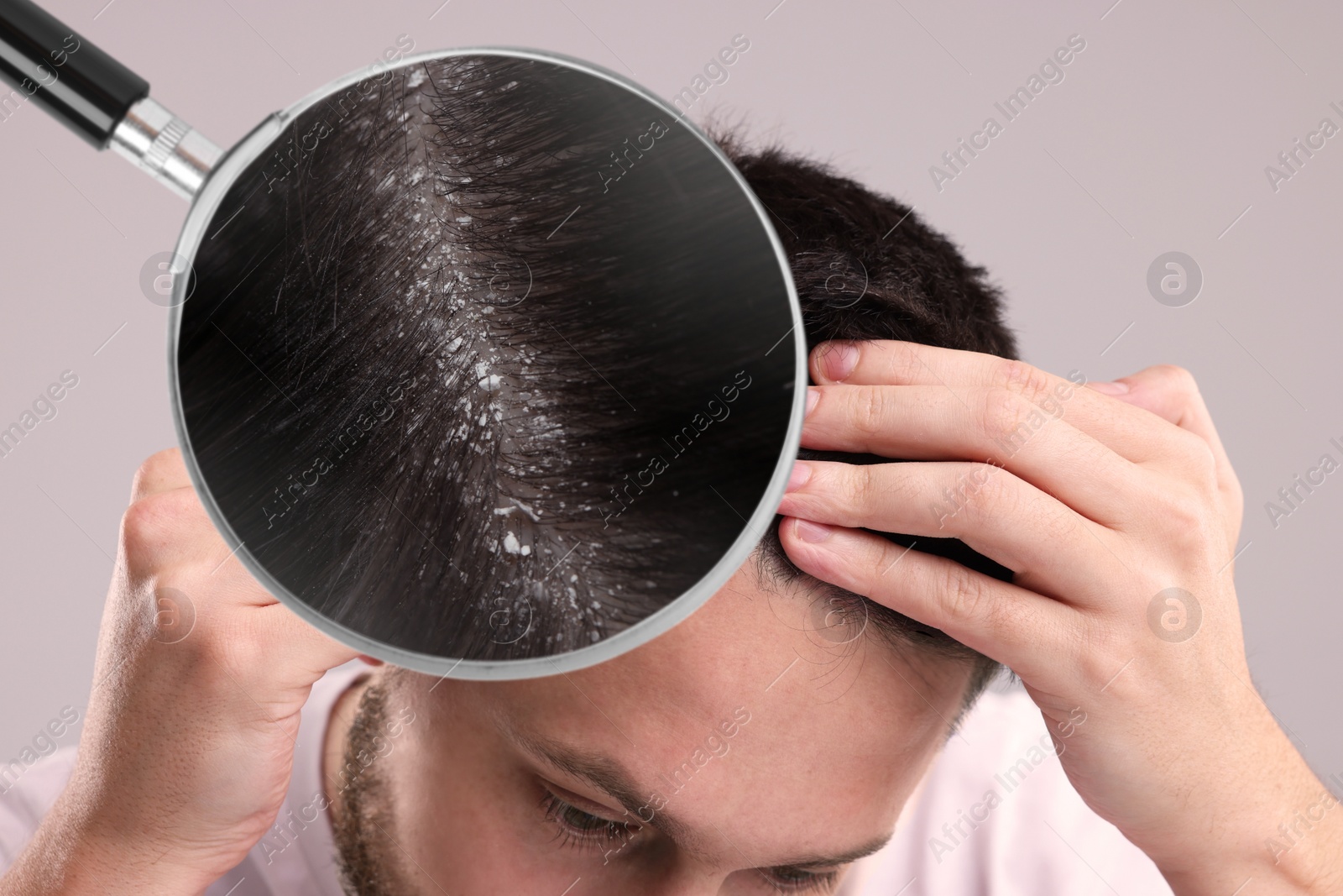 Image of Man suffering from dandruff on light grey background, closeup. View through magnifying glass on hair with flakes