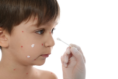 Photo of Doctor applying cream onto skin of little boy with chickenpox against white background, closeup. Varicella zoster virus