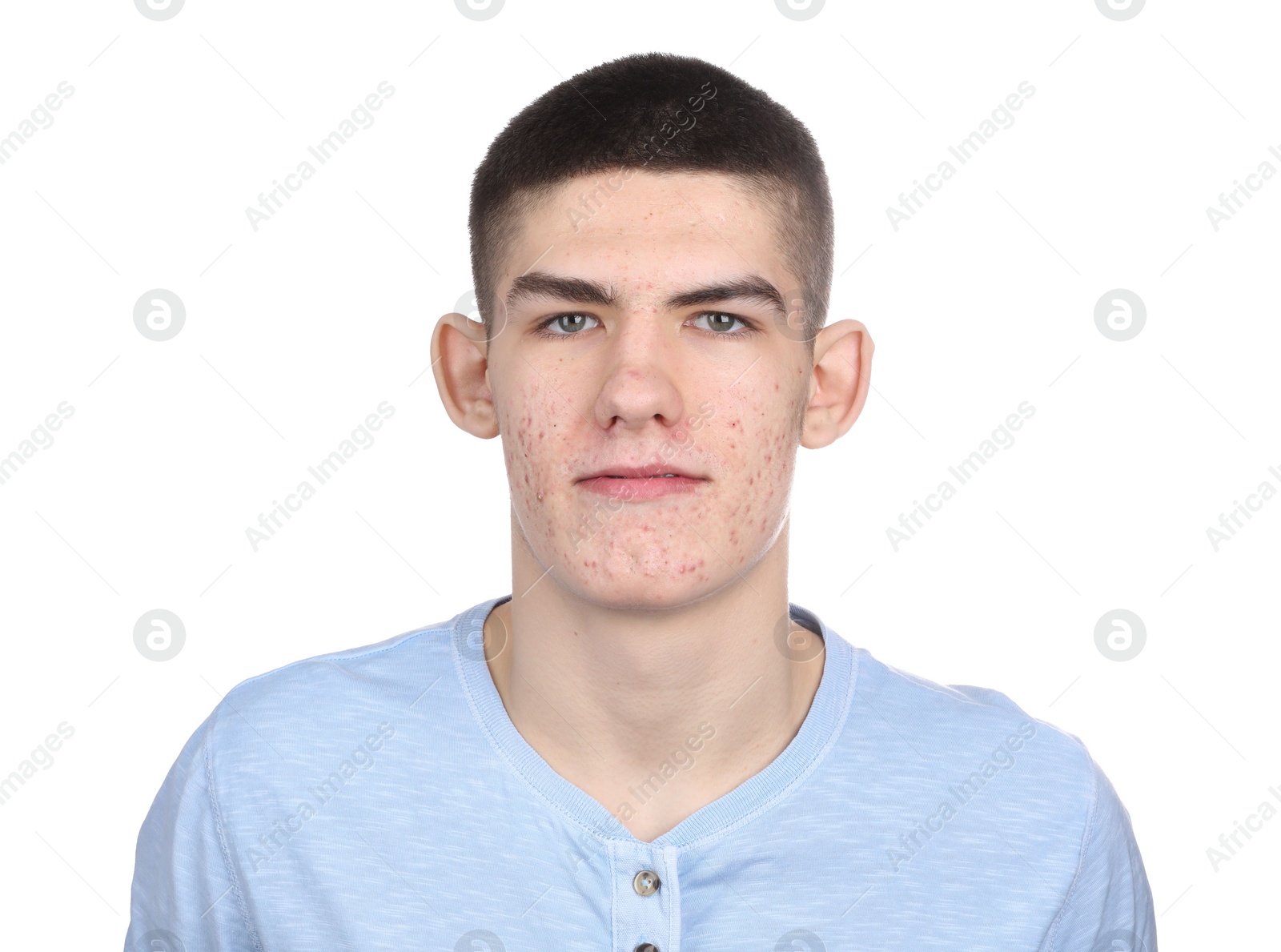 Photo of Young man with acne problem isolated on white