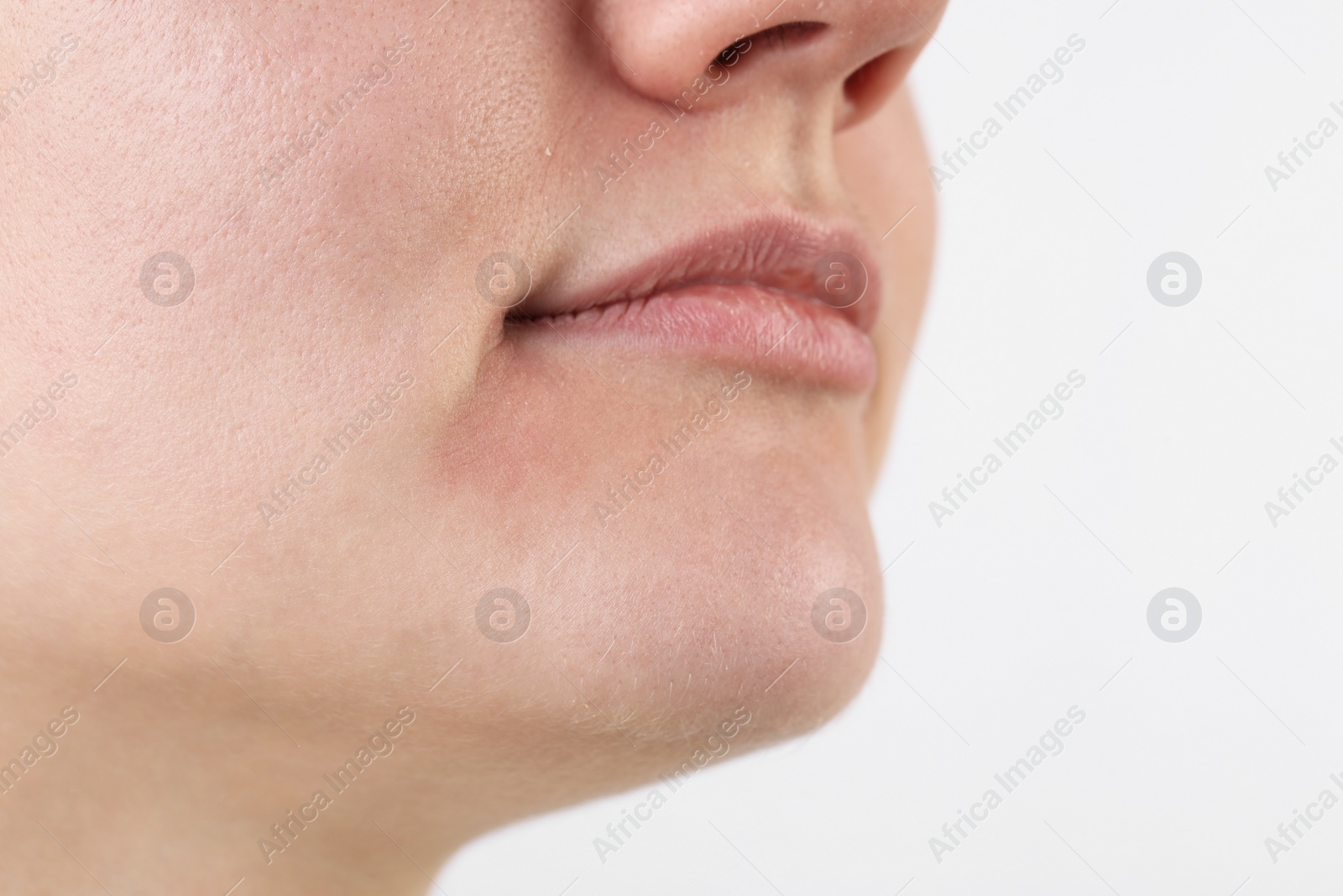 Photo of Woman with dry skin on white background, closeup view