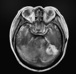 Illustration of  X-ray of patient with brain cancer. Illustration