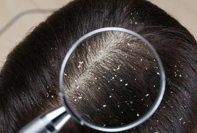 Image of Woman with dandruff in her hair, closeup. View through magnifying glass