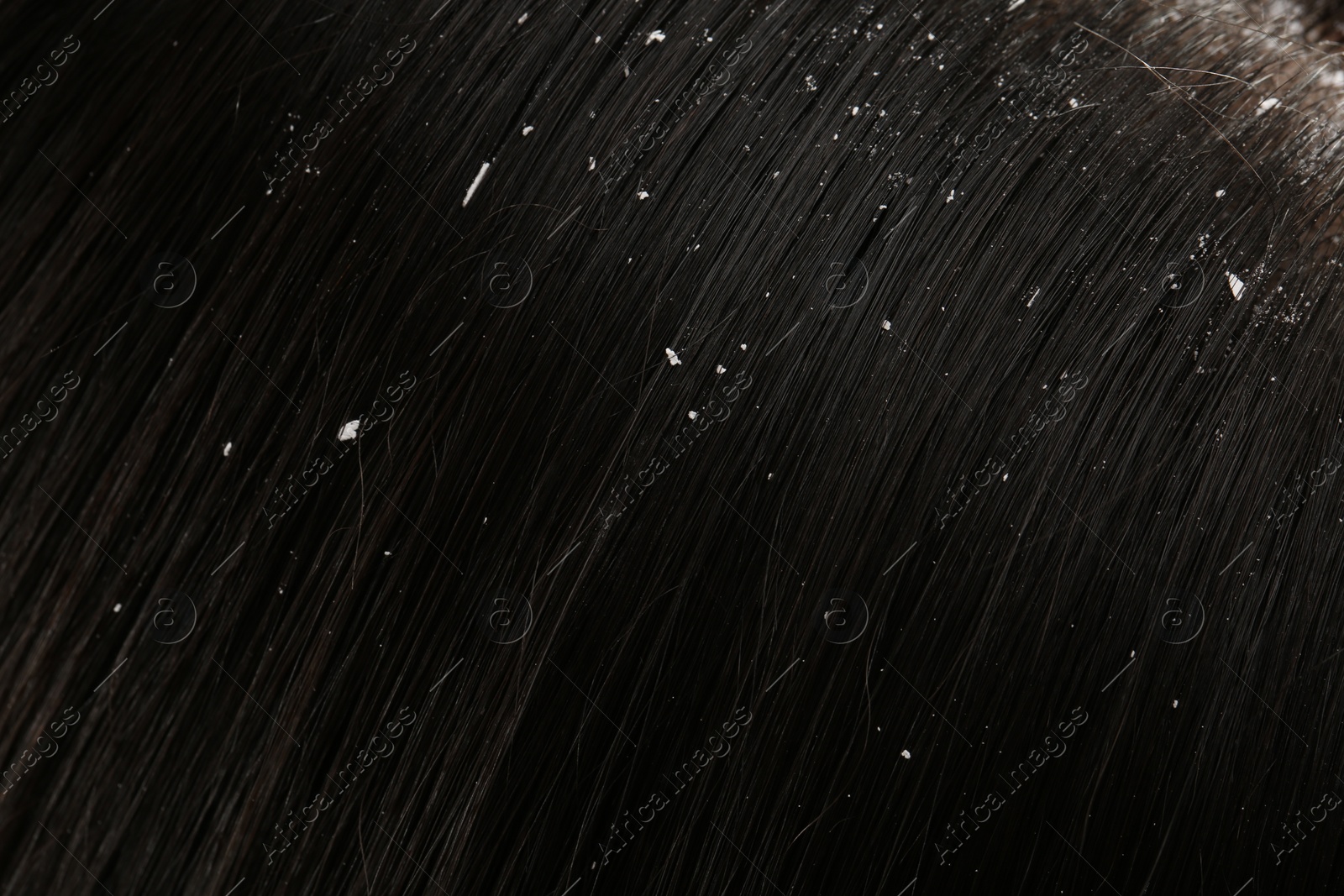 Photo of Woman with dandruff in her dark hair, closeup view