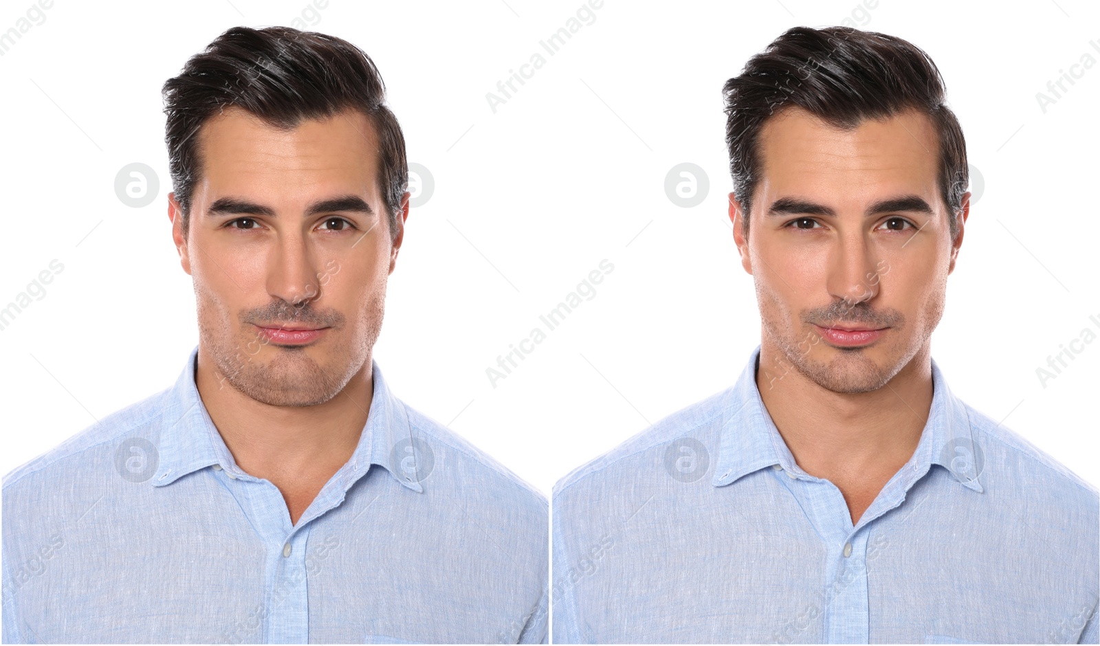 Image of Double chin problem. Collage with photos of man before and after plastic surgery procedure on white background