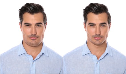 Image of Double chin problem. Collage with photos of man before and after plastic surgery procedure on white background