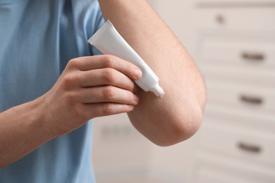 Photo of Man applying ointment from tube onto his elbow indoors, closeup