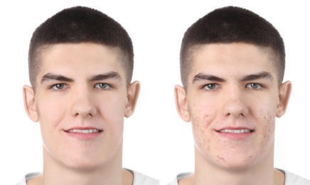 Image of Acne problem. Young man before and after treatment on white background, collage of photos