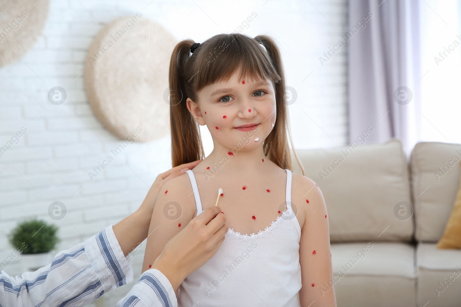 Photo of Woman applying cream onto skin of little girl with chickenpox at home