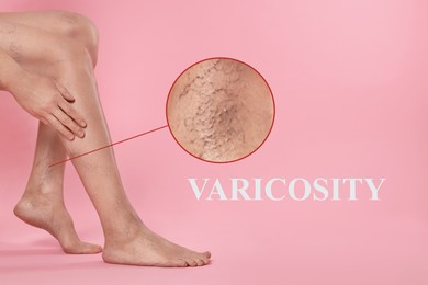 Image of Woman suffering from varicose veins on pink background, closeup. Magnified skin surface showing affected area