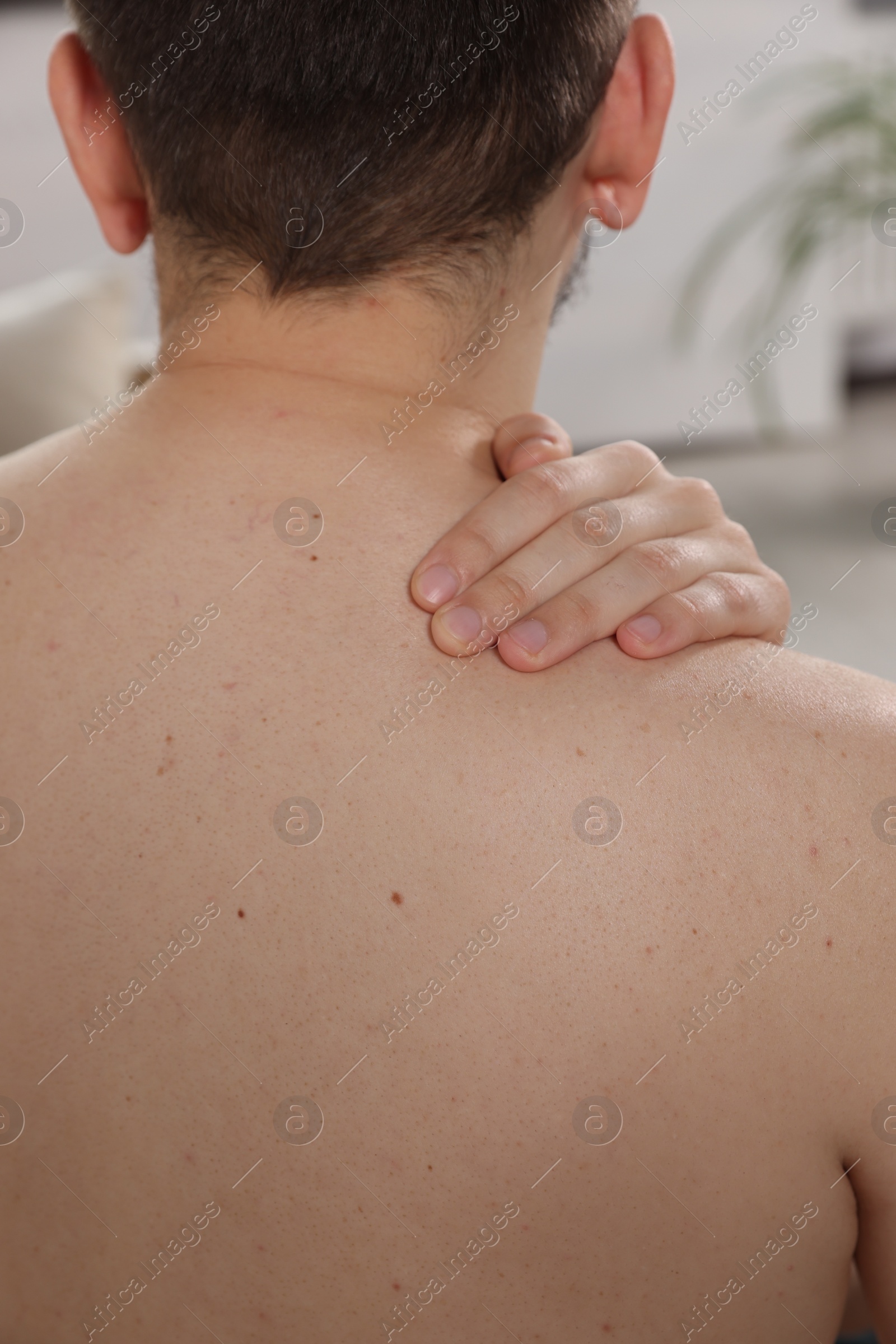 Photo of Closeup of man's body with birthmarks on blurred background, back view