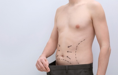 Photo of Young man with marks on belly for cosmetic surgery operation on light background