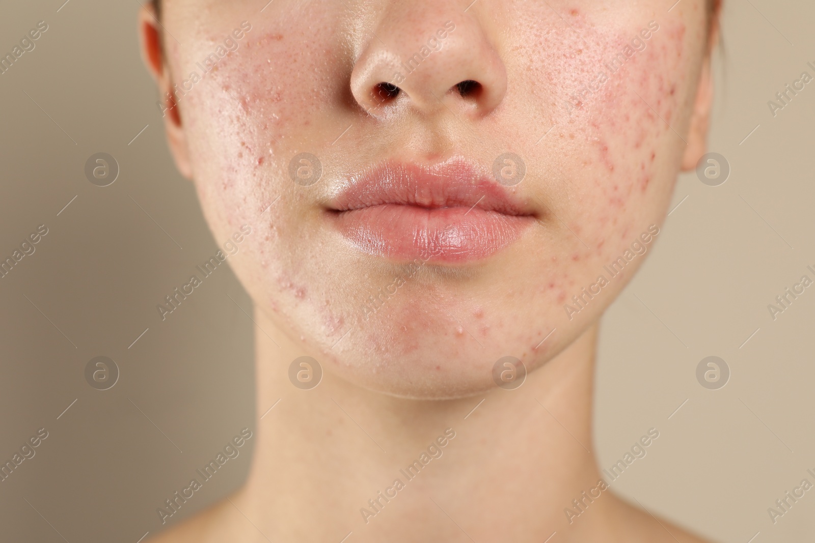 Photo of Teenage girl with acne problem on beige background, closeup