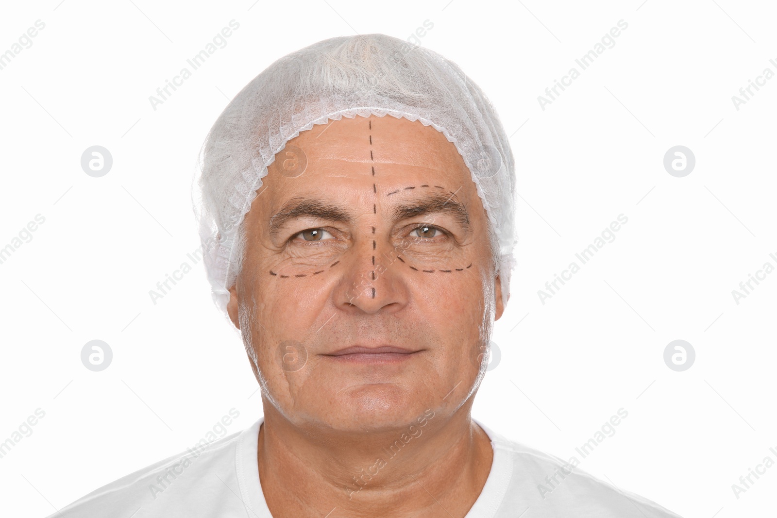 Photo of Portrait of senior man with marks on face preparing for cosmetic surgery against white background