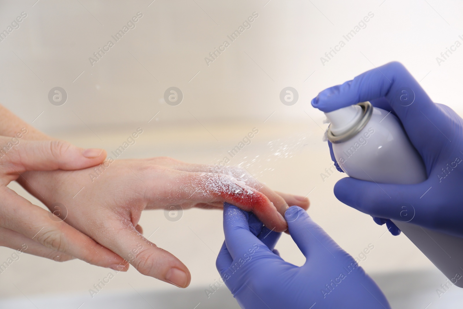 Photo of Applying burn spray onto injured skin, closeup