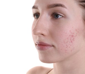 Young woman with acne problem on white background, closeup