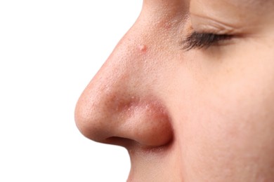 Photo of Young woman with acne problem on grey background, closeup