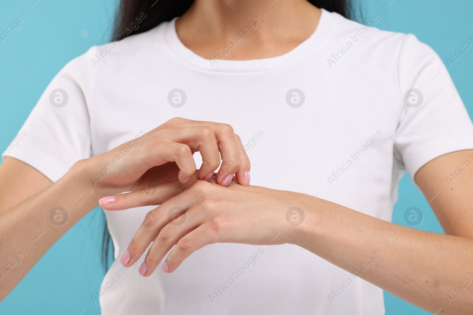 Photo of Suffering from allergy. Young woman scratching her hand on light blue background, closeup