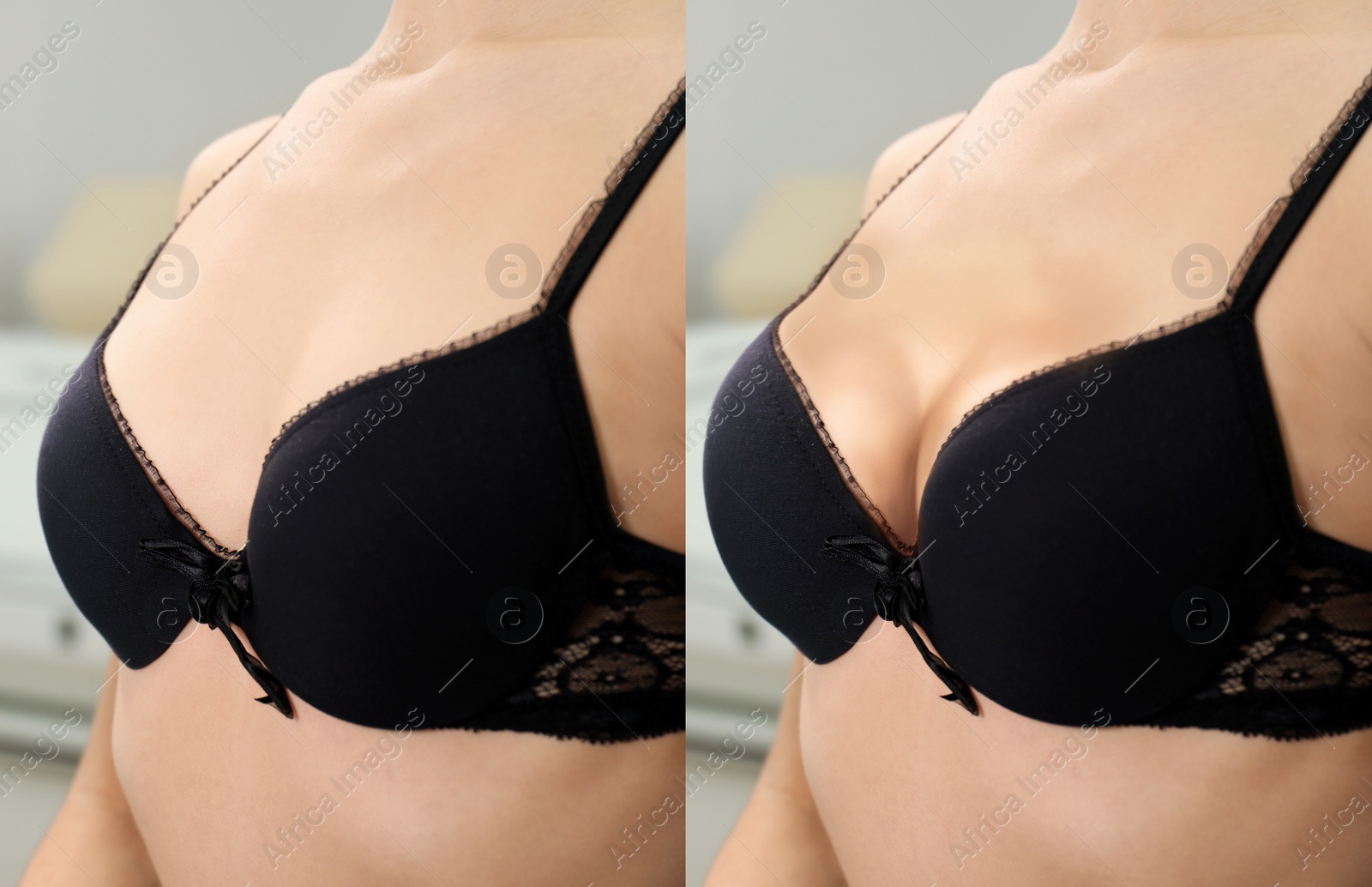 Image of Collage with photos of young woman before and after breast size correction, closeup