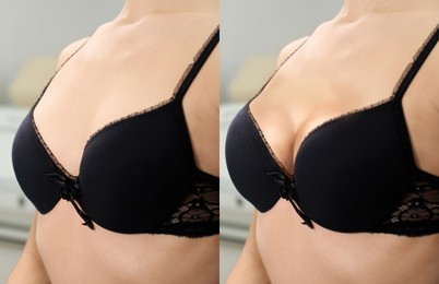 Image of Collage with photos of young woman before and after breast size correction, closeup