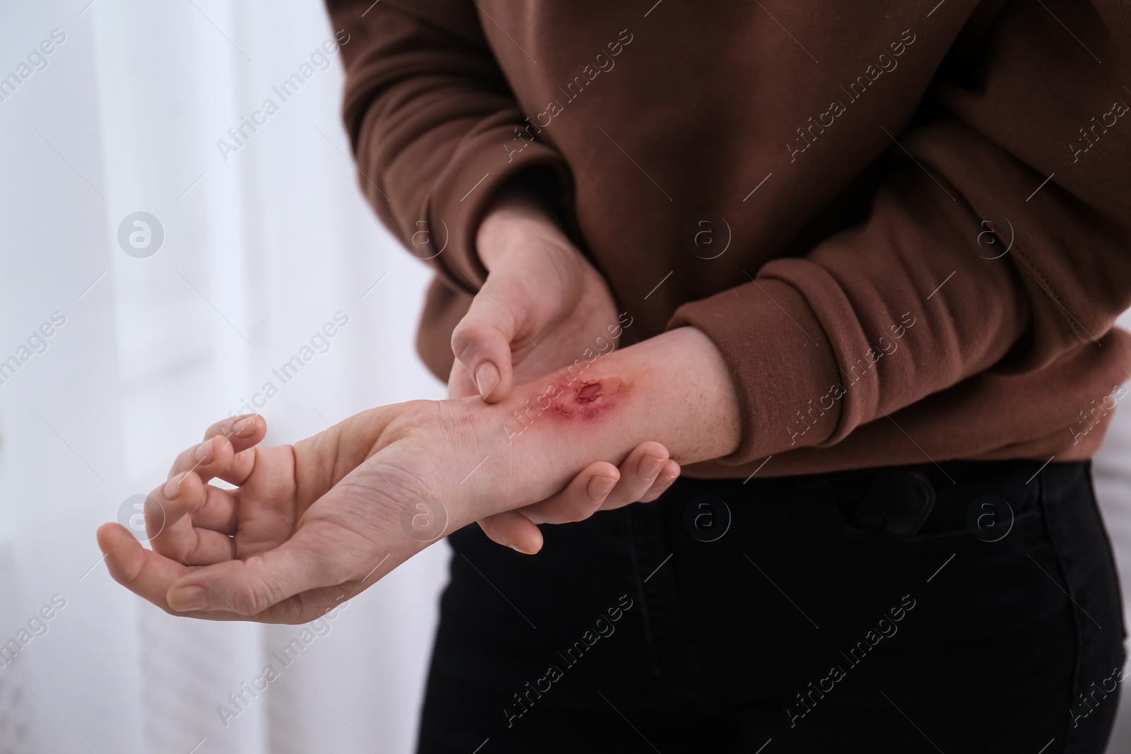 Photo of Woman with burn on her forearm indoors, closeup