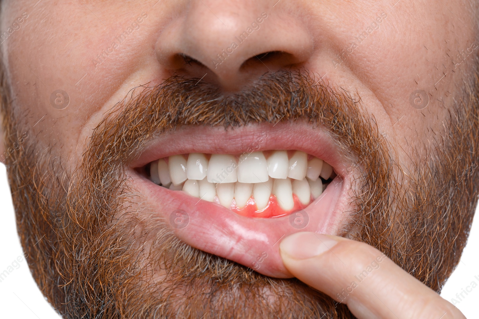 Image of Man showing inflamed gum, closeup. Oral cavity health