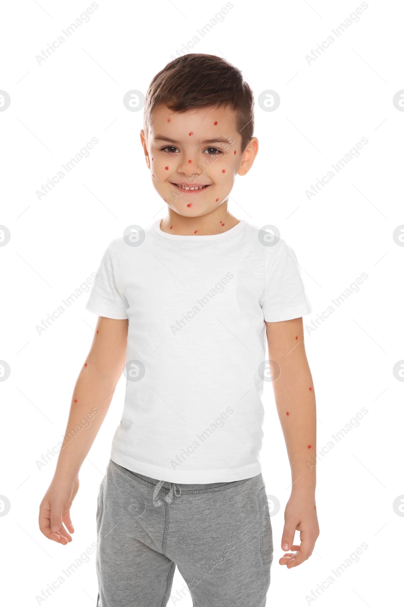 Photo of Little boy with chickenpox on white background