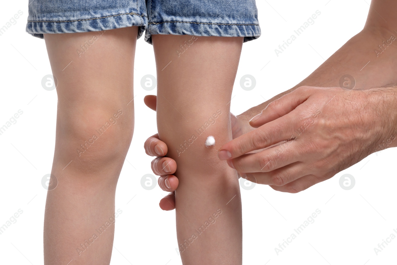 Photo of Father applying ointment to his daughter's knee on white background, closeup
