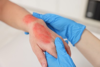 Doctor examining patient's burned hand indoors, closeup