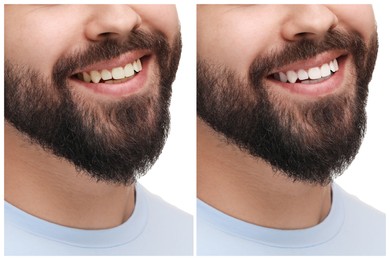 Image of Man showing teeth before and after whitening on white background, collage