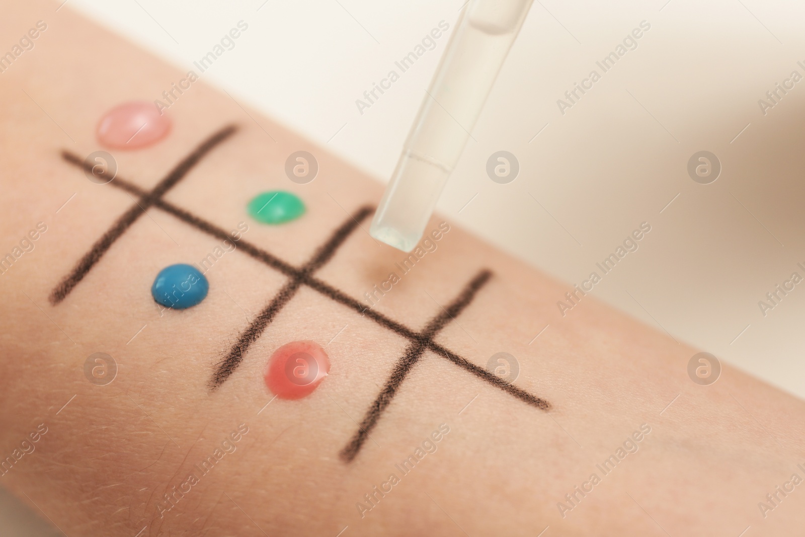 Photo of Patient undergoing skin allergy test at light table, closeup