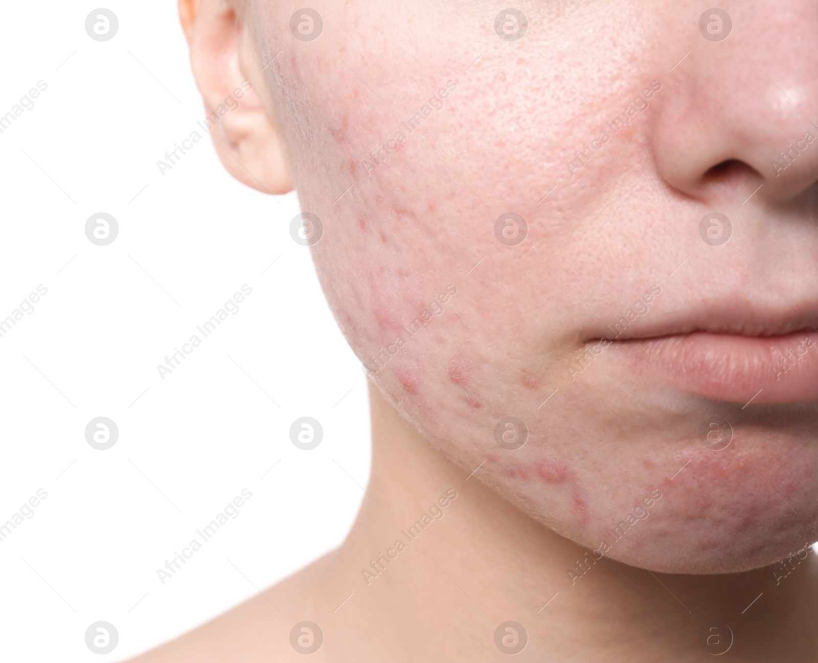 Photo of Young woman with acne problem on white background