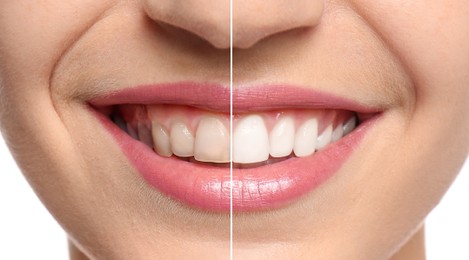 Image of Collage with photos of woman before and after teeth whitening, closeup. Banner design