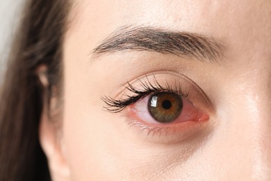 Woman with red eye suffering from conjunctivitis, closeup