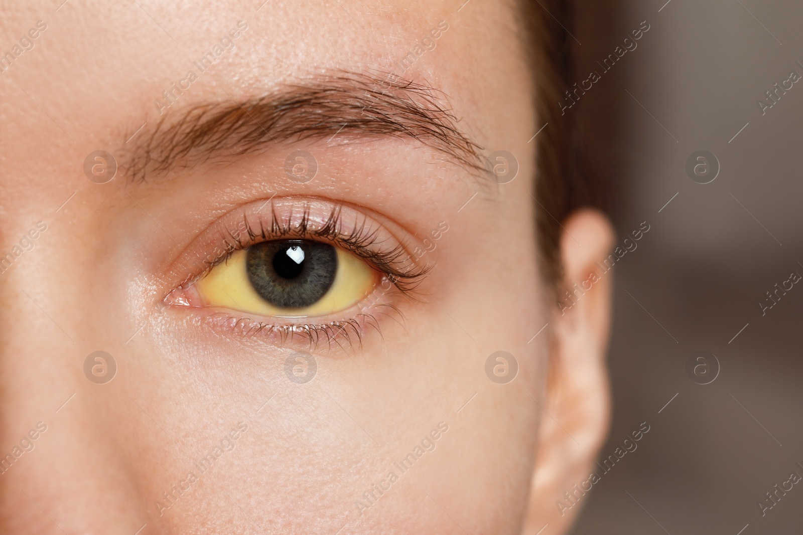 Photo of Woman with yellow eyes on blurred background, closeup. Symptom of hepatitis