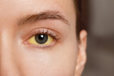 Woman with yellow eyes on blurred background, closeup. Symptom of hepatitis