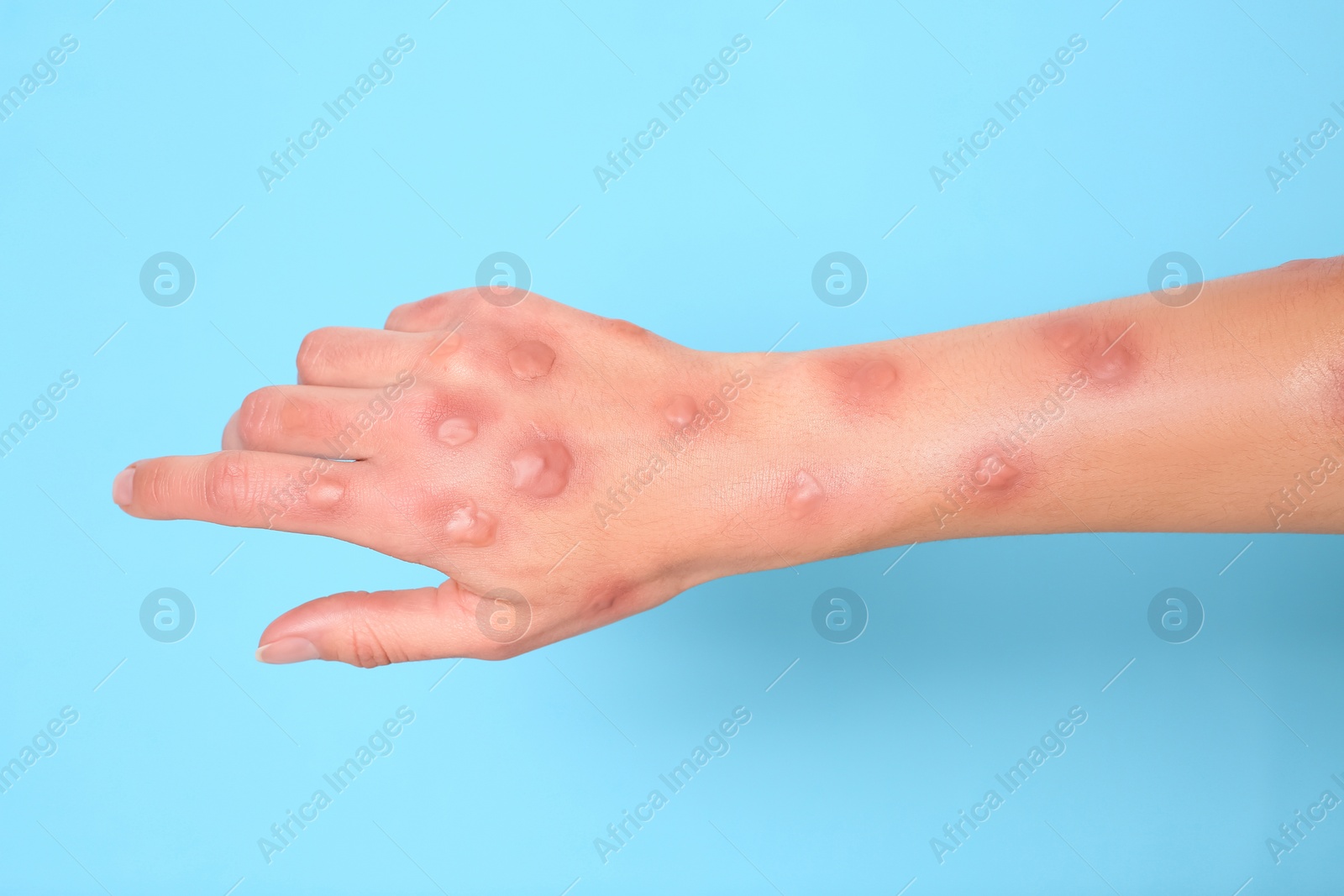 Photo of Woman with rash suffering from monkeypox virus on light blue background, closeup