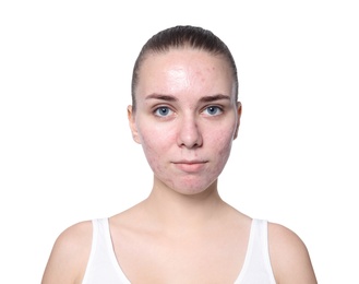 Young woman with acne problem on white background