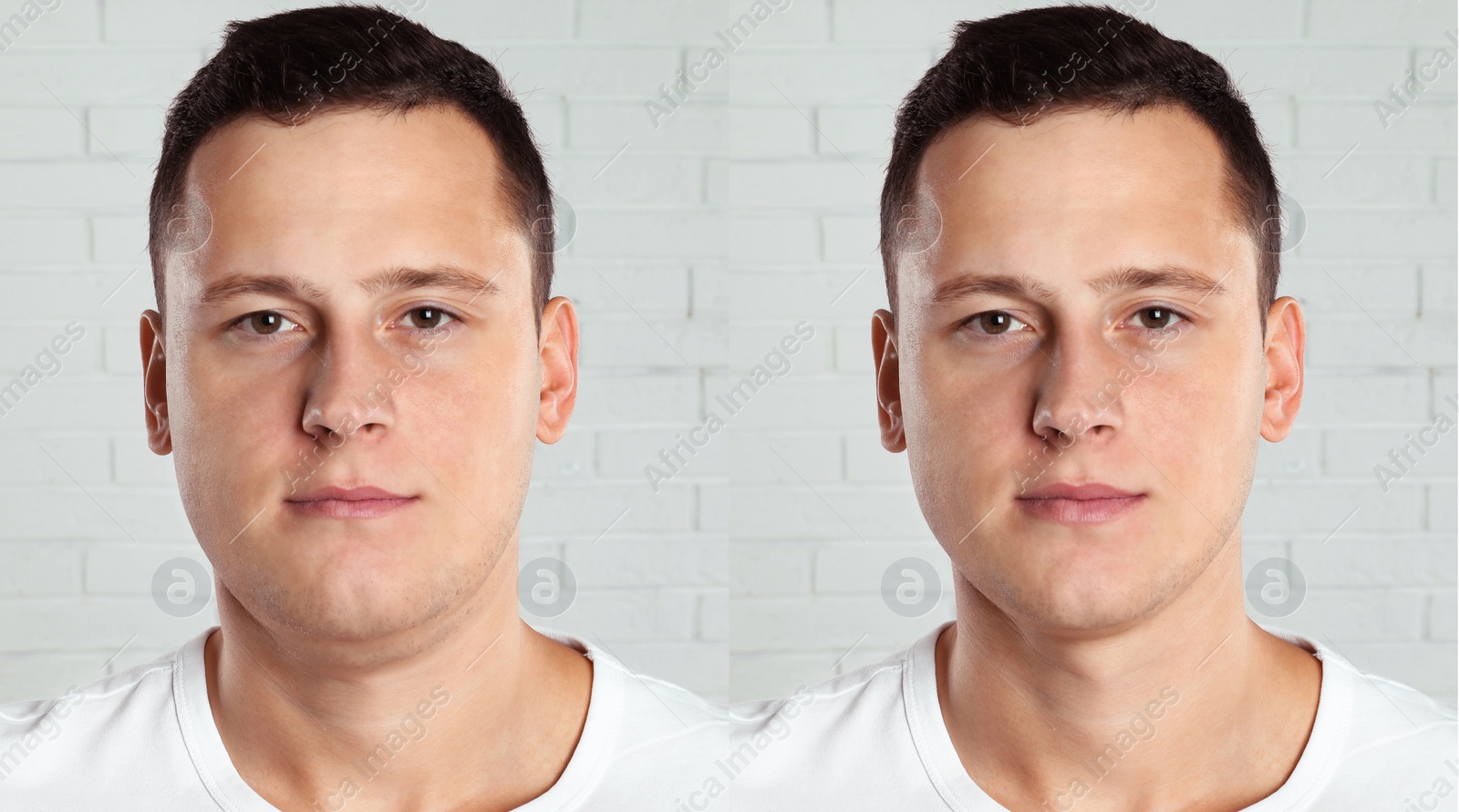 Image of Double chin problem. Collage with photos of man before and after plastic surgery procedure near white brick wall, banner design