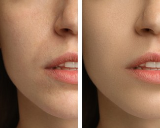 Image of Collage with photos of woman having dry skin problem before and after moisturizing, closeup