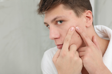 Photo of Teen guy with acne problem squeezing pimple in bathroom, closeup