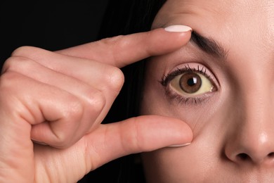 Photo of Woman checking her health condition on black background, closeup. Yellow eyes as symptom of problems with liver