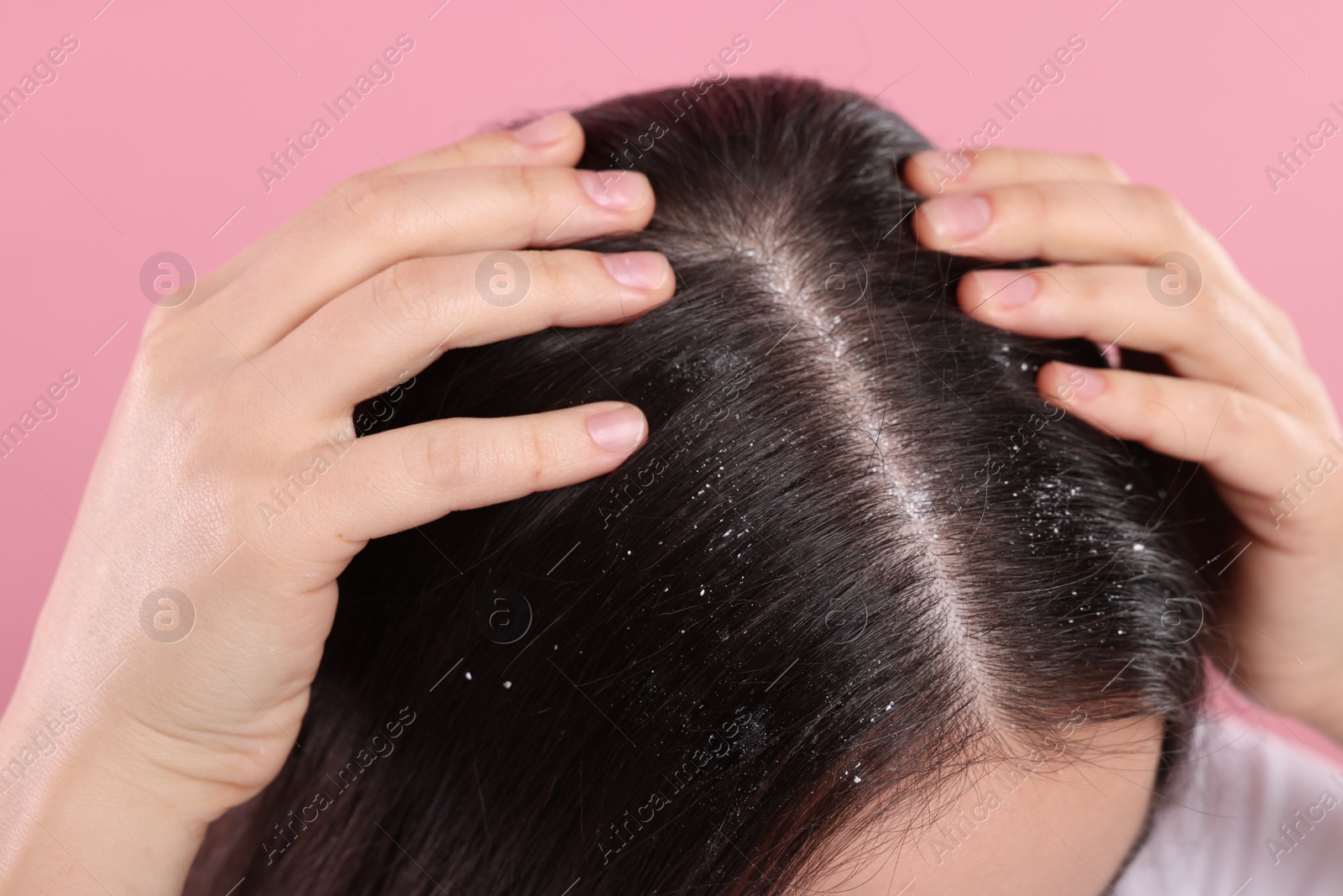 Photo of Woman with dandruff problem on pink background, closeup